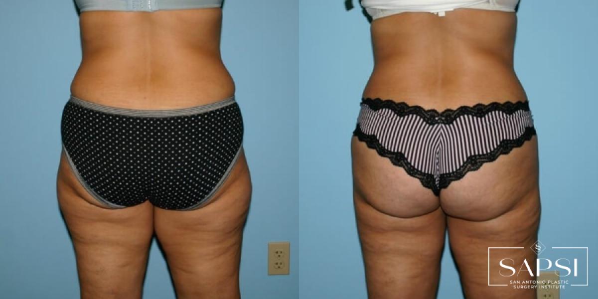 Liposuction: Patient 10 - Before and After 2