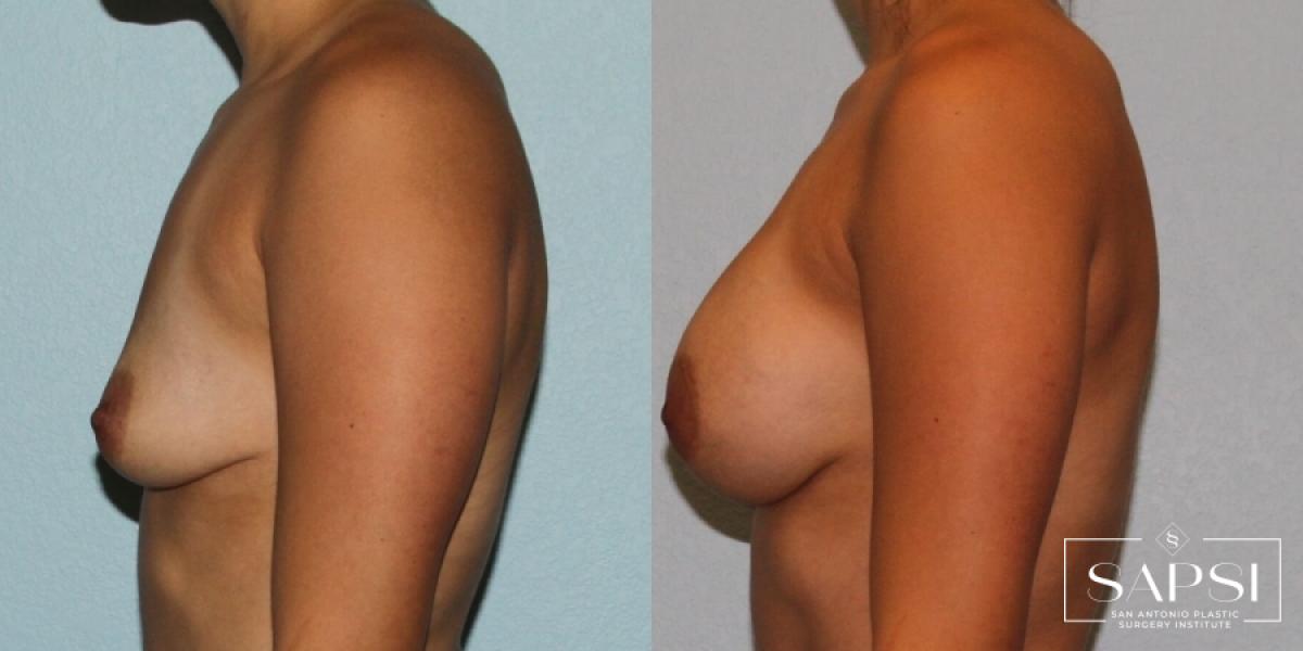 Breast Augmentation: Patient 81 - Before and After 3