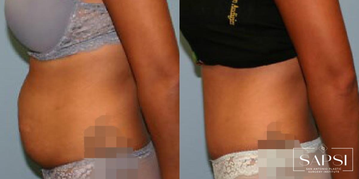 Tummy Tuck: Patient 41 - Before and After 3