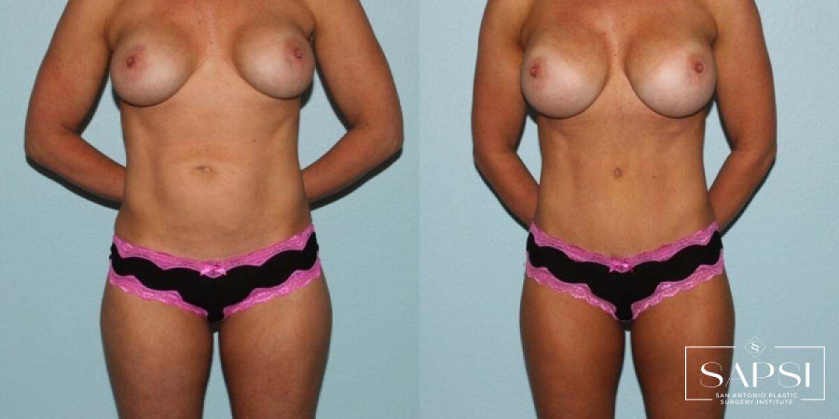 Breast Revision: Patient 10 - Before and After  