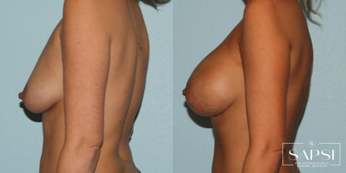 Breast Augmentation: Patient 2 - Before and After 3