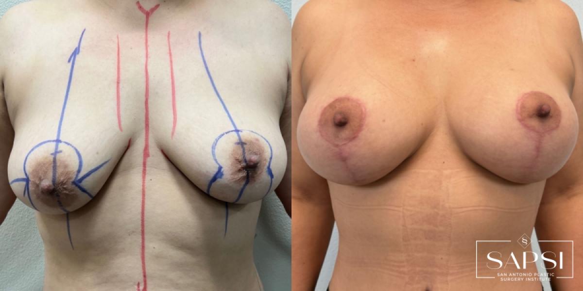 Breast Augmentation With Lift: Patient 23 - Before and After 1