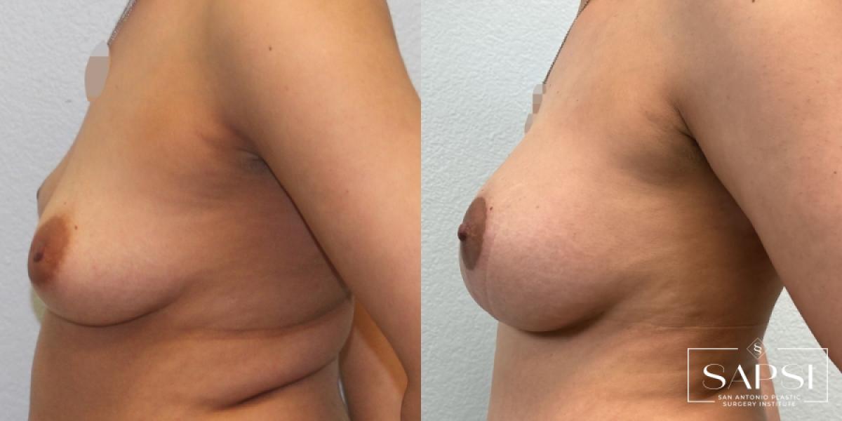 Unilateral Breast Lift: Patient 1 - Before and After 3