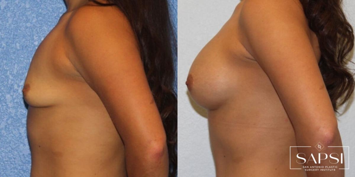 Breast Augmentation: Patient 79 - Before and After 3