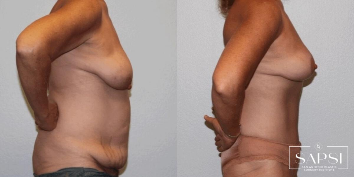 Body Contouring: Patient 7 - Before and After 3