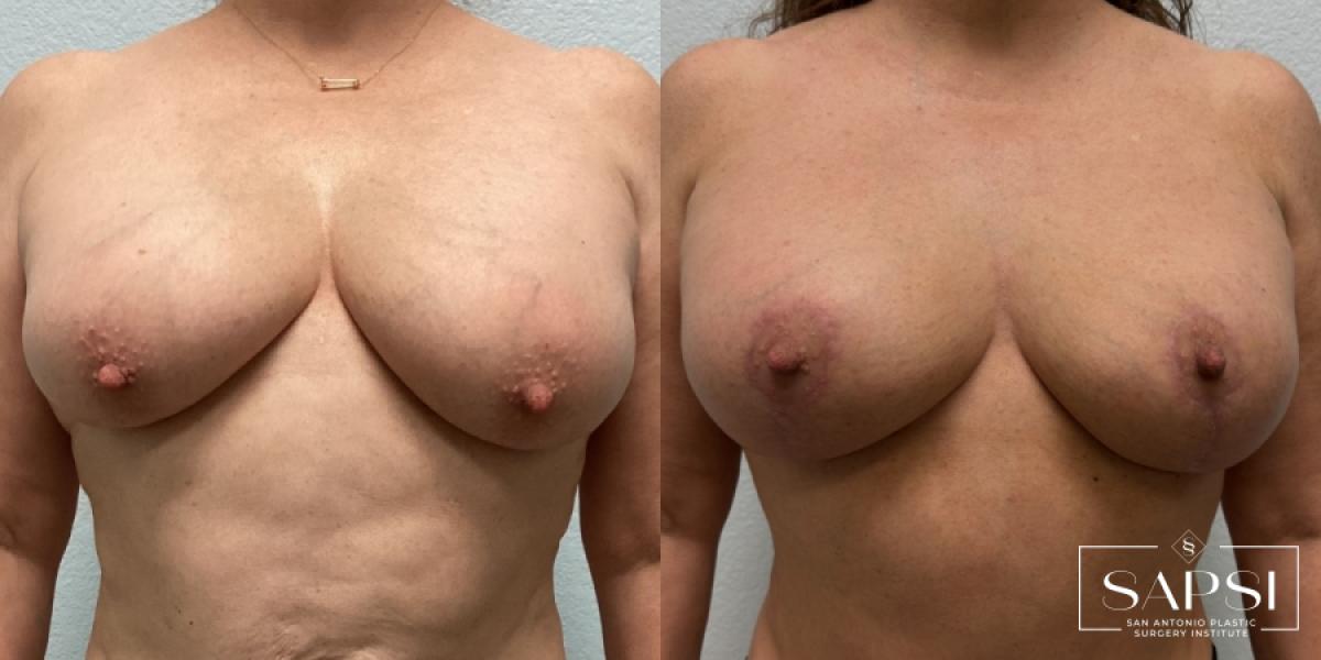 Breast Reduction: Patient 6 - Before and After  