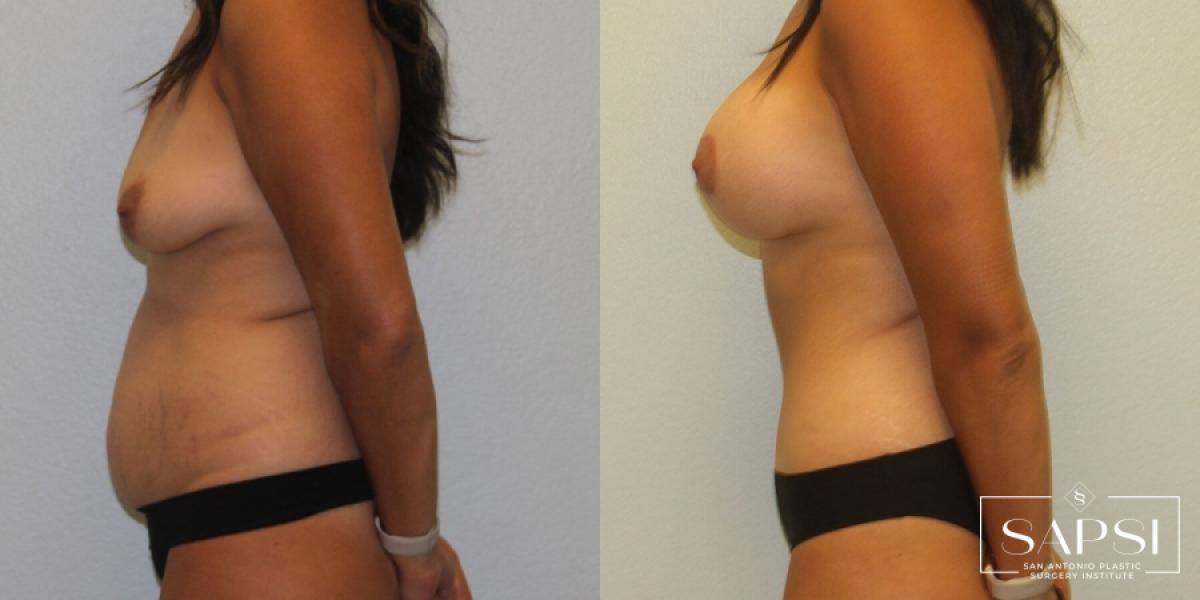 Breast Augmentation With Lift: Patient 2 - Before and After 3