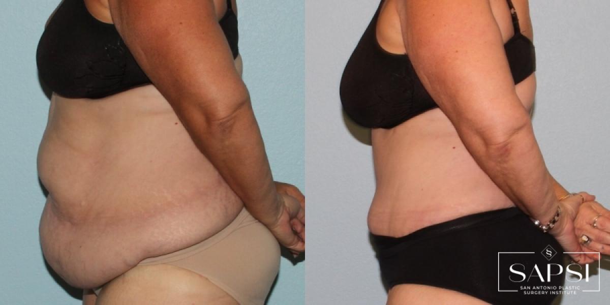 Liposuction: Patient 15 - Before and After 3