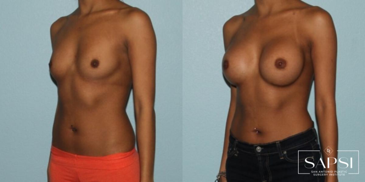 Breast Augmentation: Patient 43 - Before and After 2