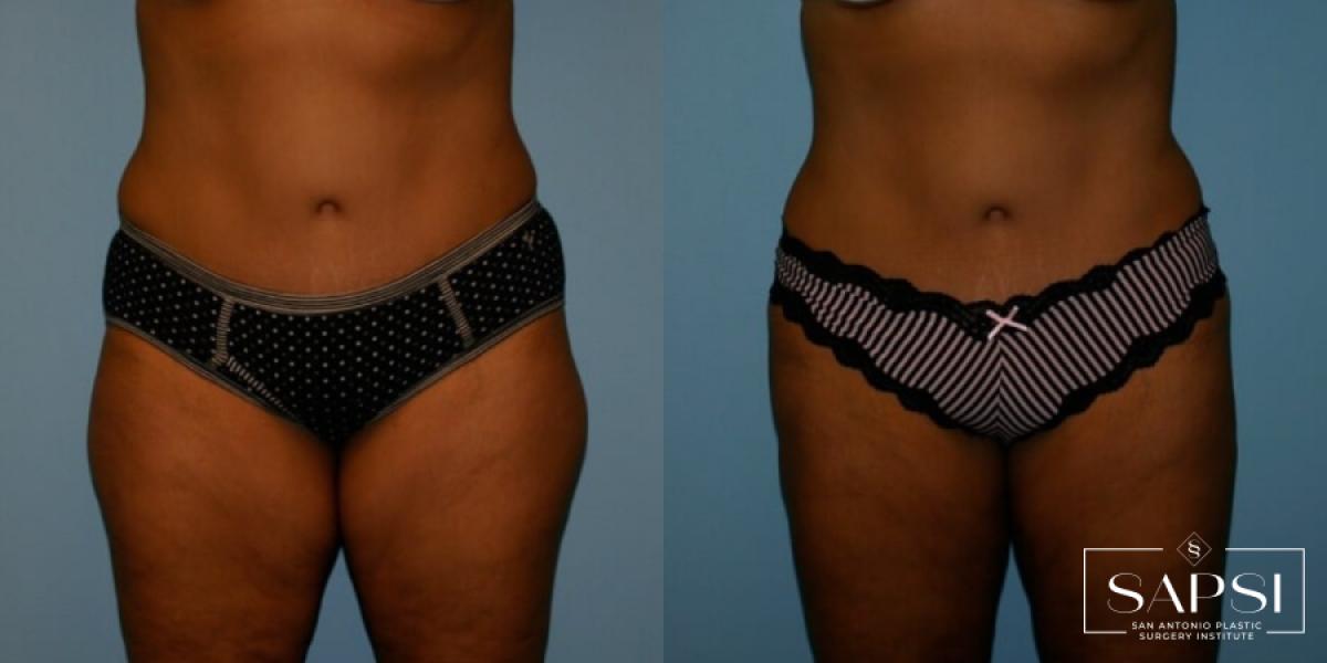 Liposuction: Patient 10 - Before and After  