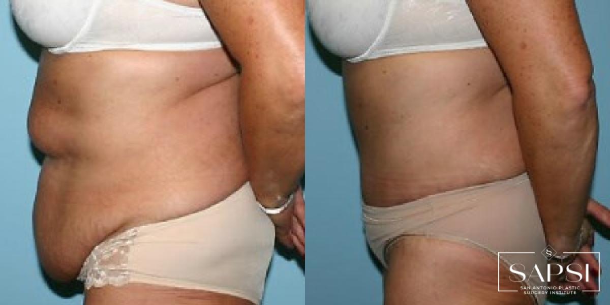 Tummy Tuck: Patient 39 - Before and After 3