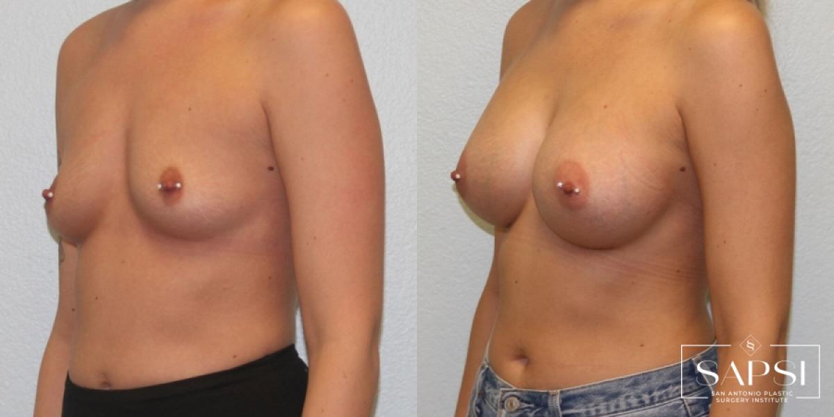 Breast Augmentation: Patient 32 - Before and After 2