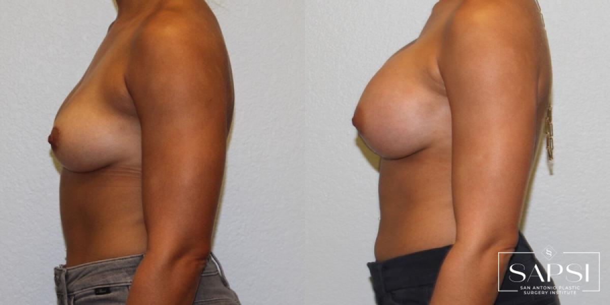 Breast Augmentation: Patient 25 - Before and After 3