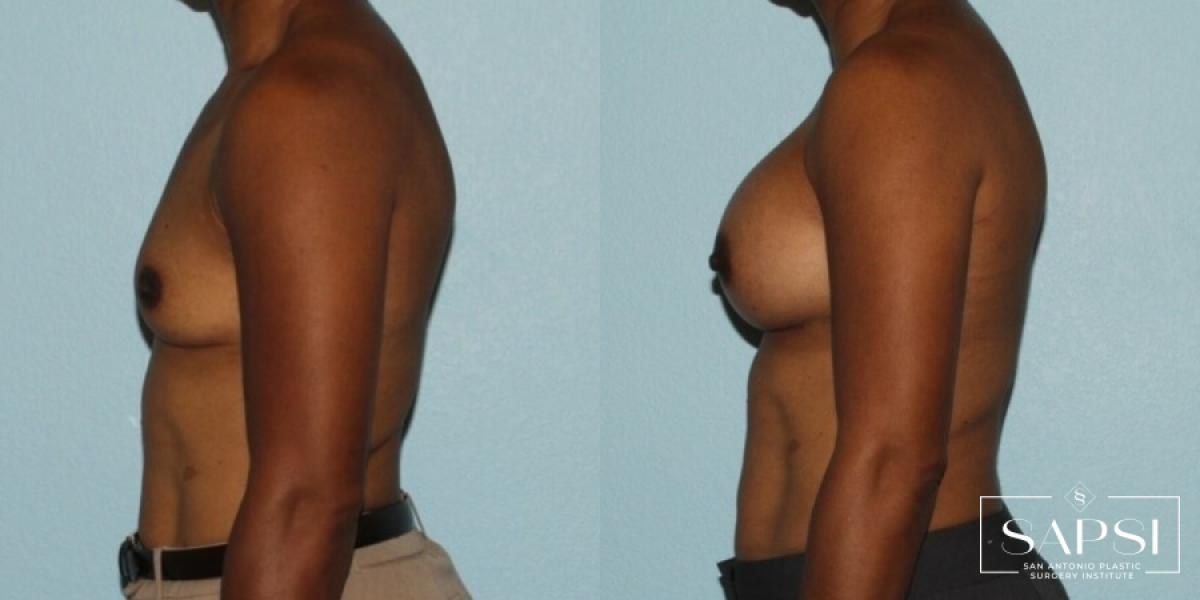 Breast Augmentation: Patient 13 - Before and After 3