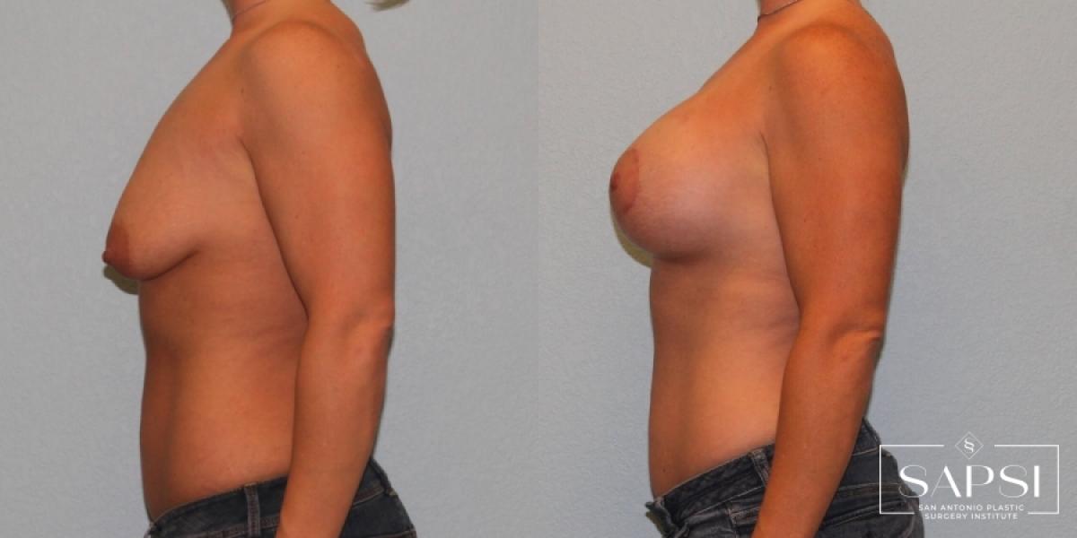 Breast Augmentation With Lift: Patient 11 - Before and After 3