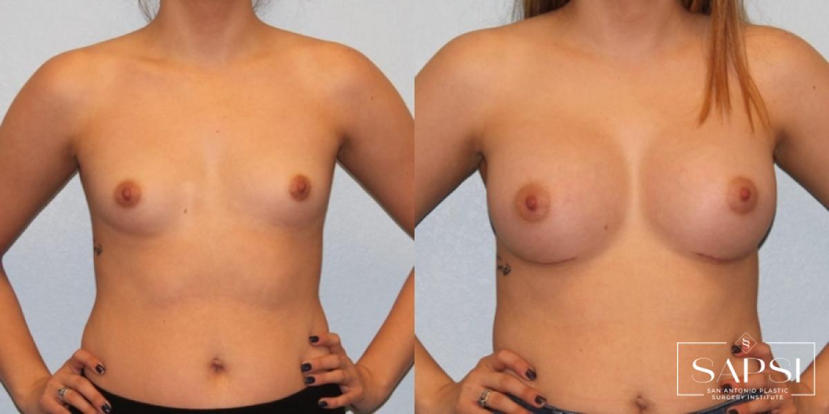 Breast Augmentation: Patient 35 - Before and After 1