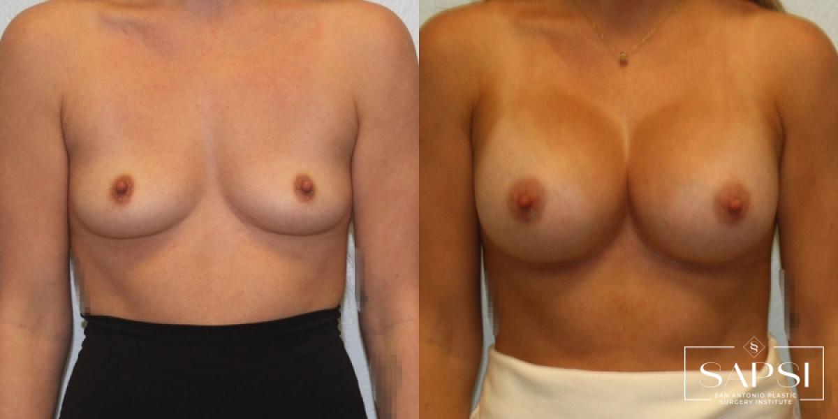 Breast Augmentation: Patient 59 - Before and After 1