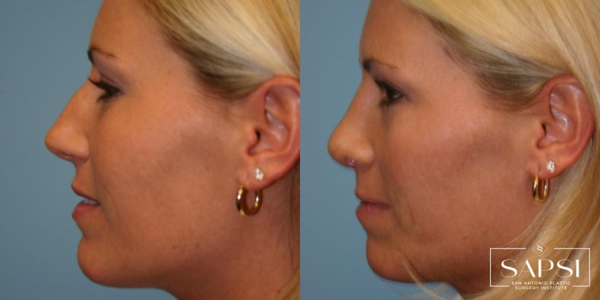 Facelift: Patient 4 - Before and After 2