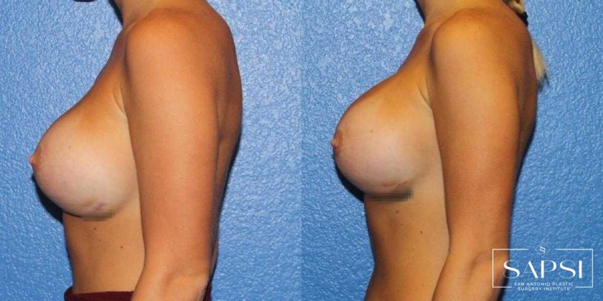 Breast Revision: Patient 13 - Before and After 3