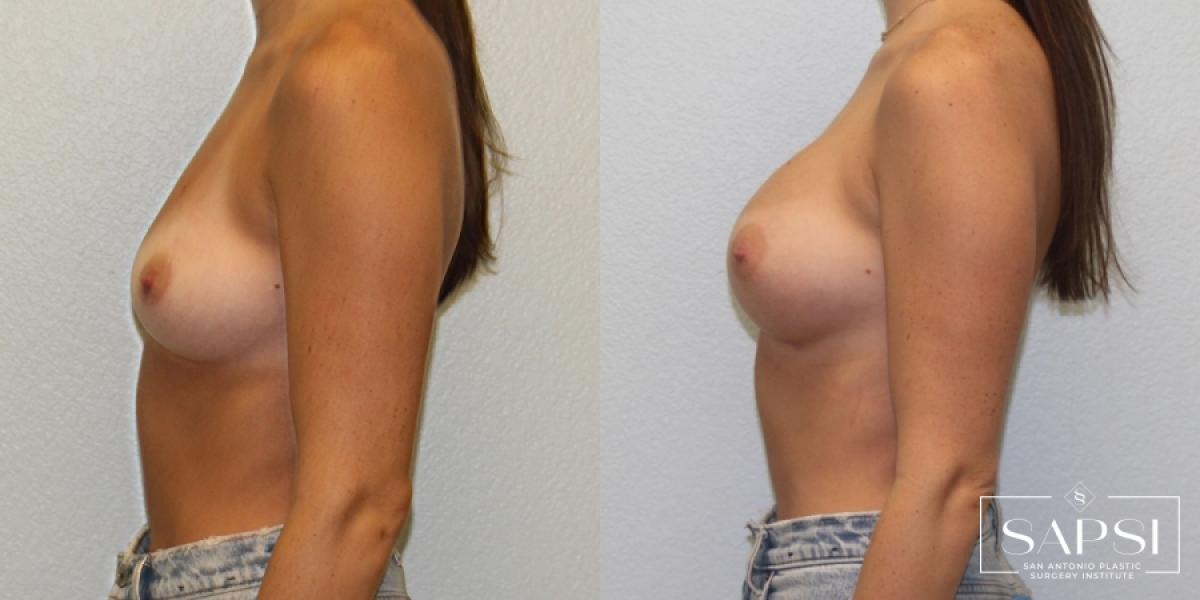 Breast Augmentation: Patient 61 - Before and After 3