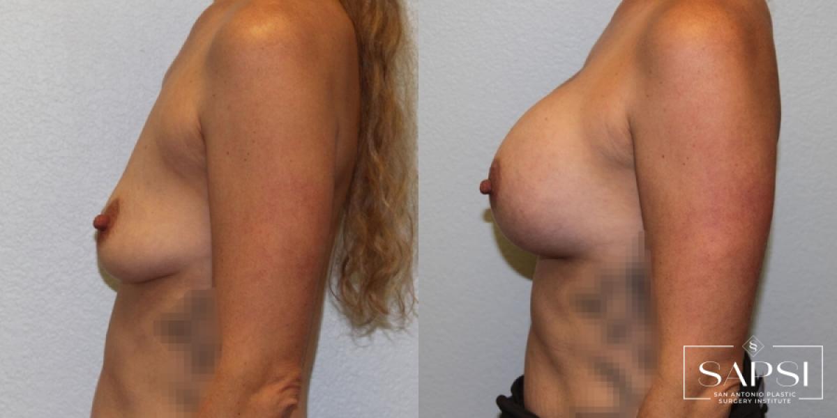 Breast Augmentation: Patient 24 - Before and After 3