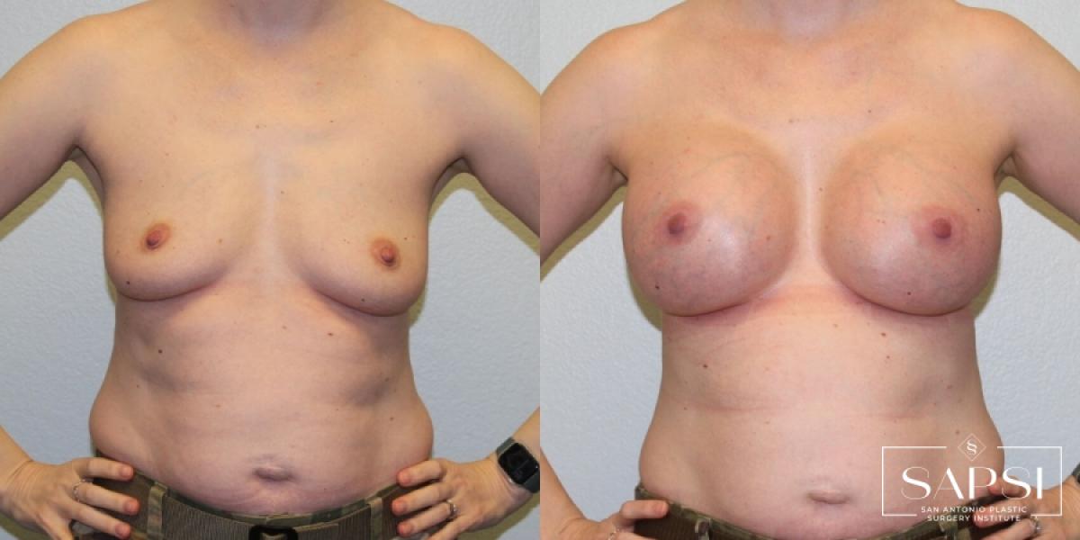 Breast Augmentation: Patient 32 - Before and After 