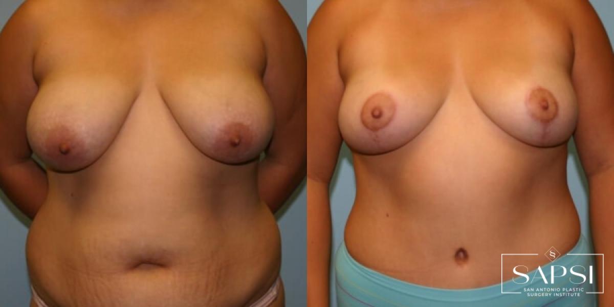 Breast Lift: Patient 17 - Before and After 1