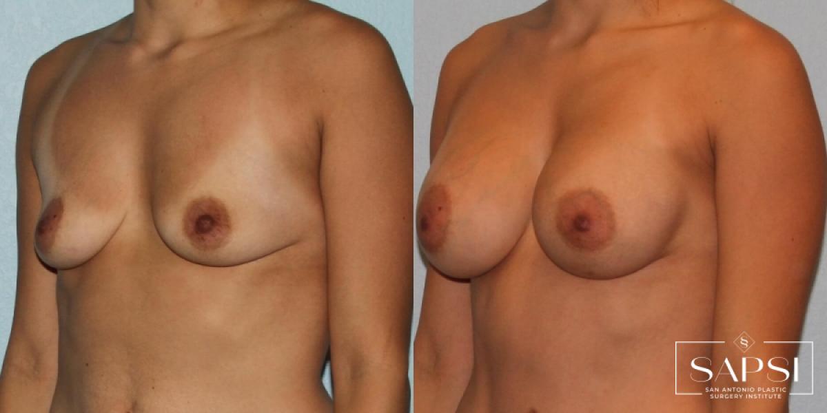 Breast Augmentation: Patient 81 - Before and After 2