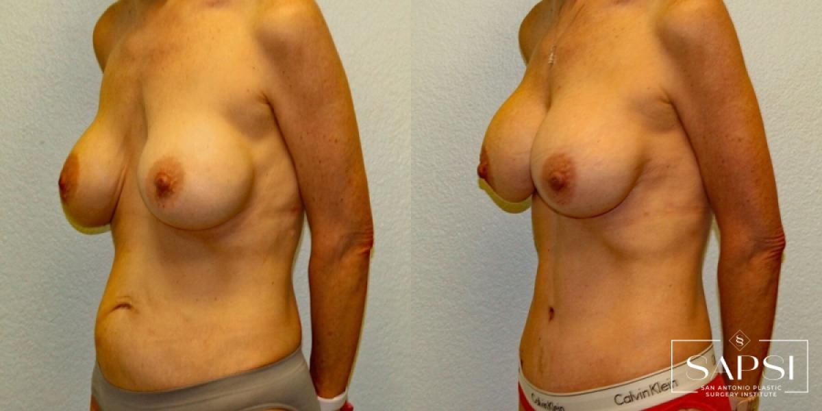 Breast Revision: Patient 2 - Before and After 2