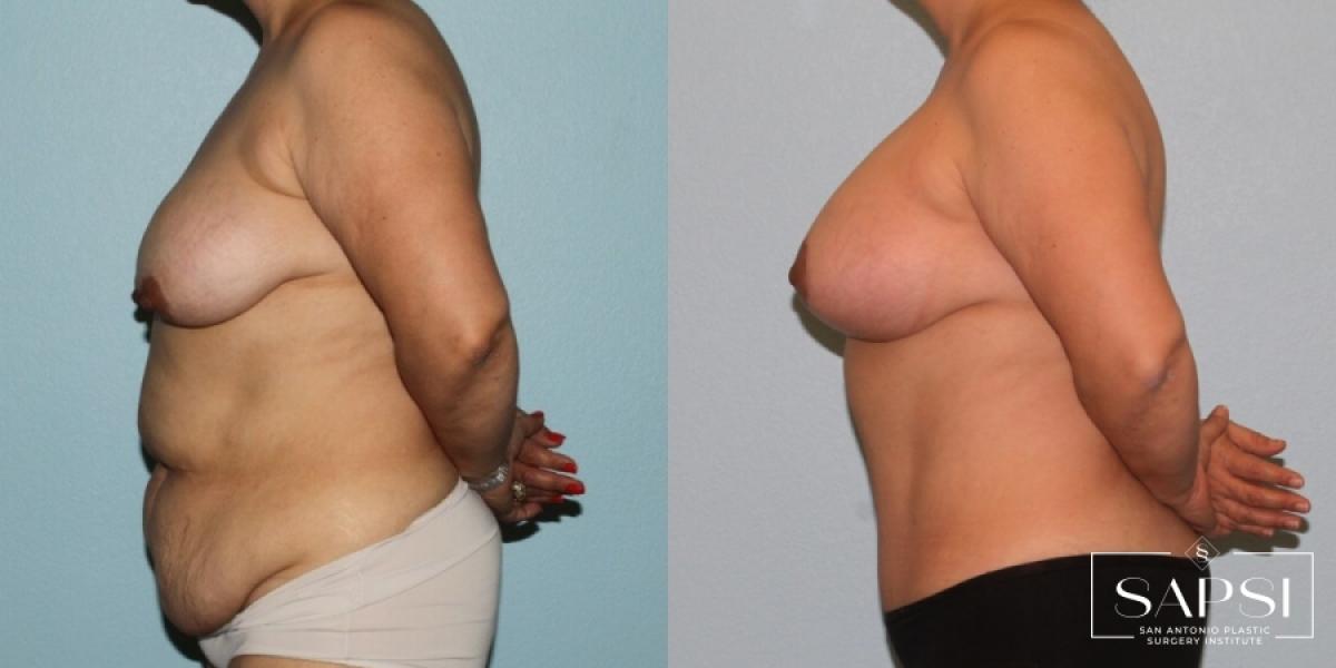 Breast Augmentation With Lift: Patient 6 - Before and After 3