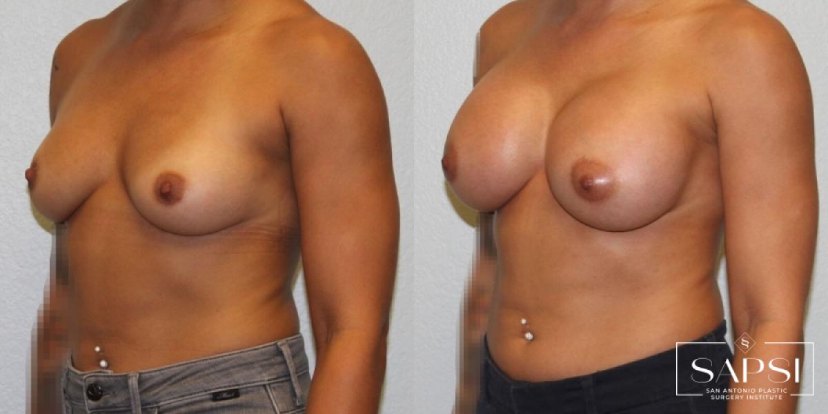 Breast Augmentation: Patient 25 - Before and After 2