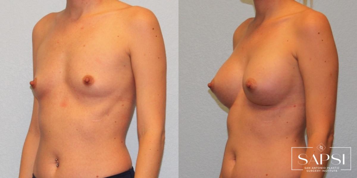 Breast Augmentation: Patient 23 - Before and After 2