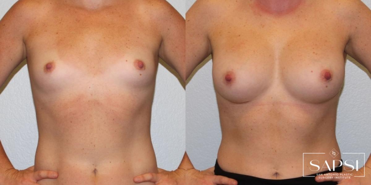 Breast Augmentation: Patient 31 - Before and After 