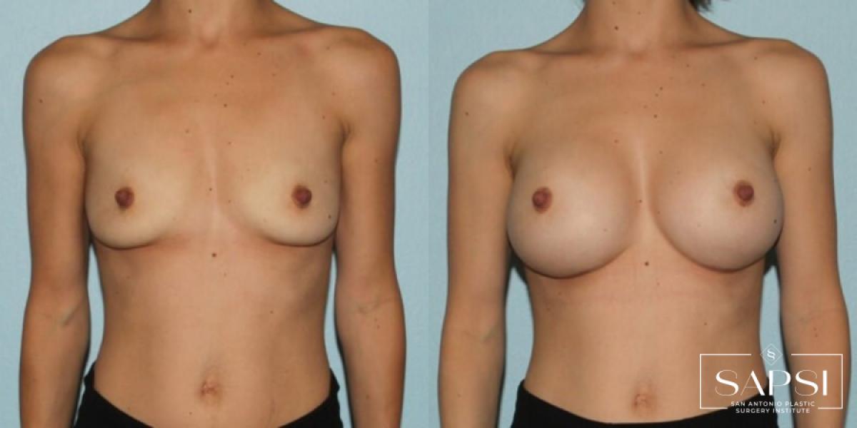 Breast Augmentation: Patient 12 - Before and After 