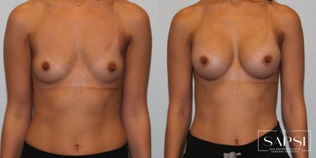 Breast Augmentation: Patient 27 - Before and After 1