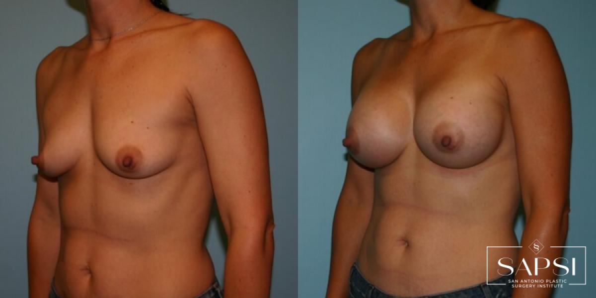 Breast Augmentation: Patient 5 - Before and After 2