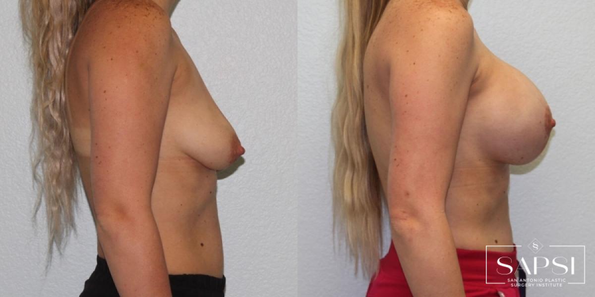 Breast Lift: Patient 4 - Before and After 3