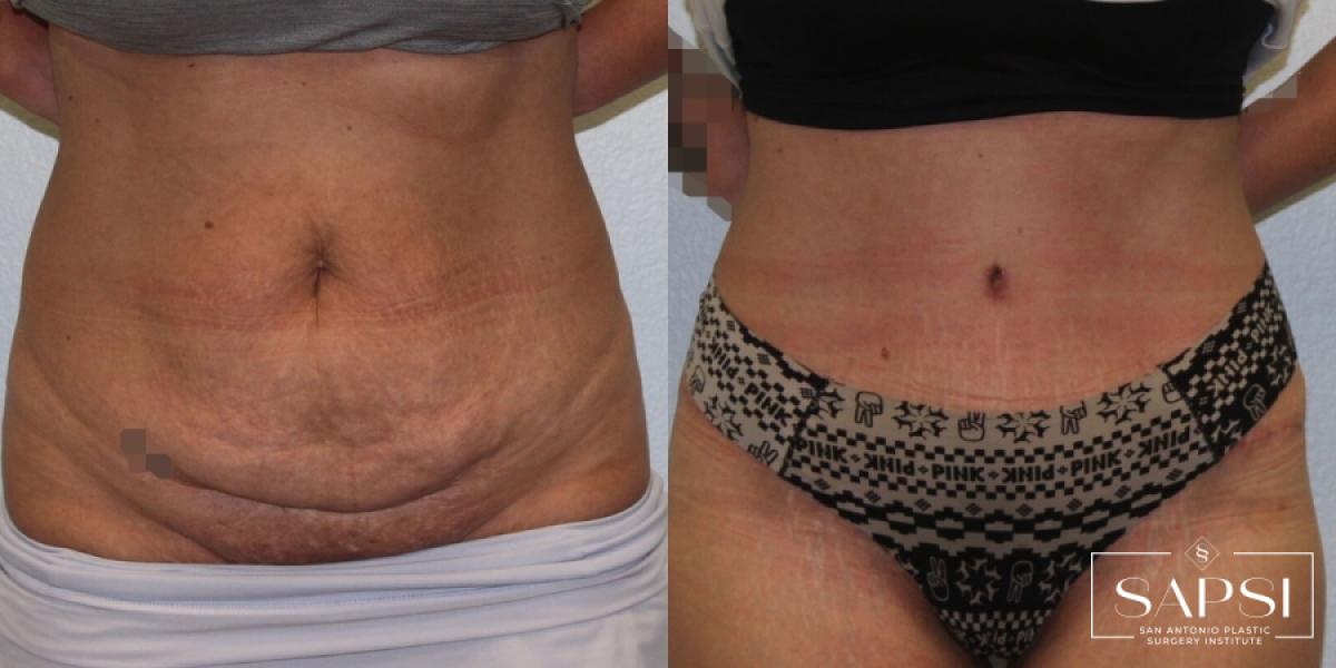 Tummy Tuck: Patient 23 - Before and After 1