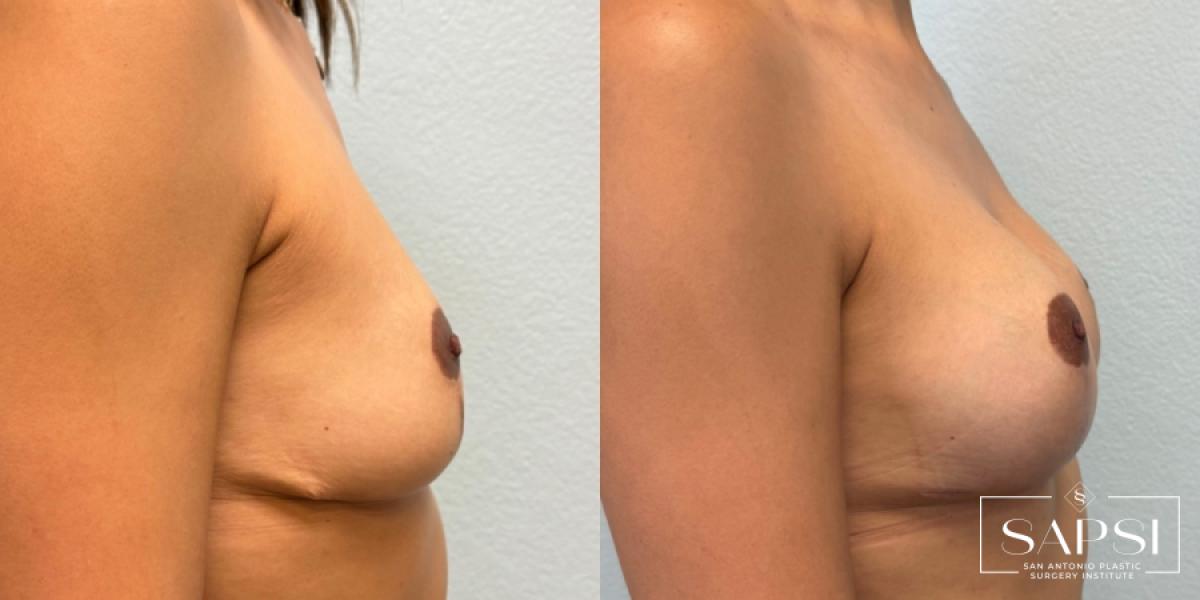 Breast Revision: Patient 11 - Before and After 3