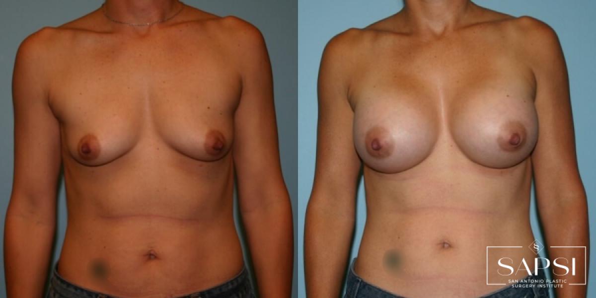 Breast Augmentation: Patient 5 - Before and After  