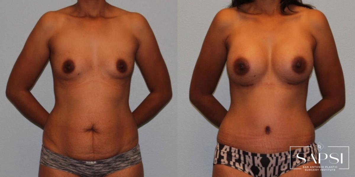 Breast Augmentation: Patient 72 - Before and After 1