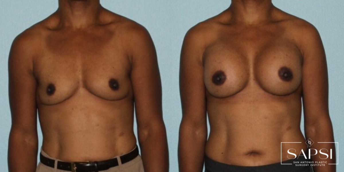 Breast Augmentation: Patient 14 - Before and After 