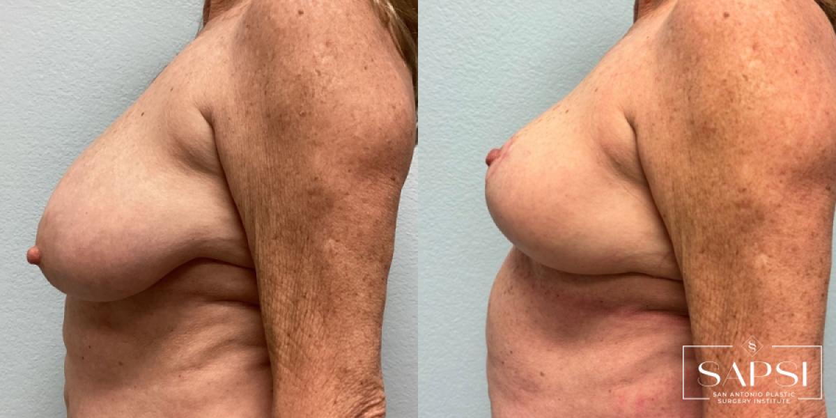 Breast Reduction: Patient 1 - Before and After 3