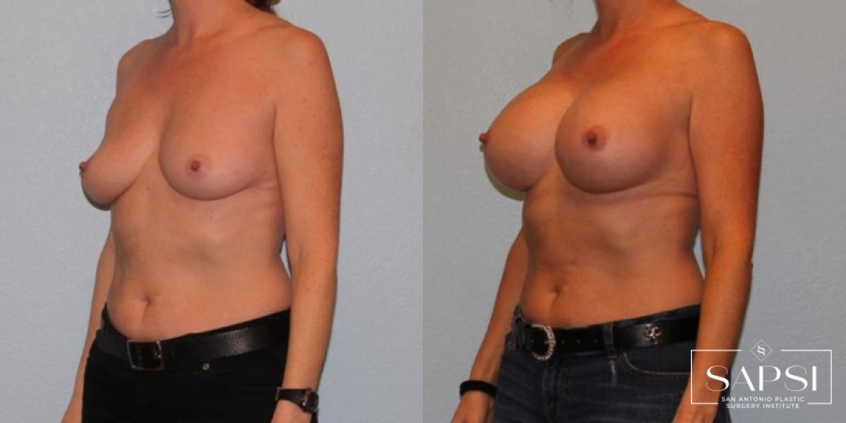 Breast Augmentation: Patient 38 - Before and After 2