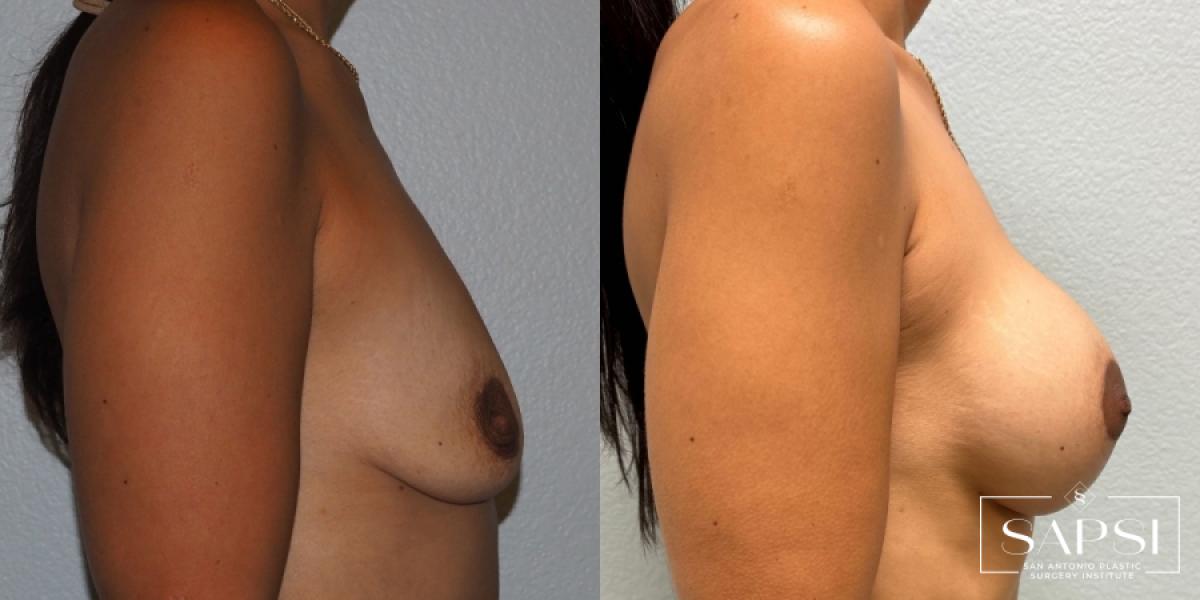 Breast Augmentation With Lift: Patient 22 - Before and After 2