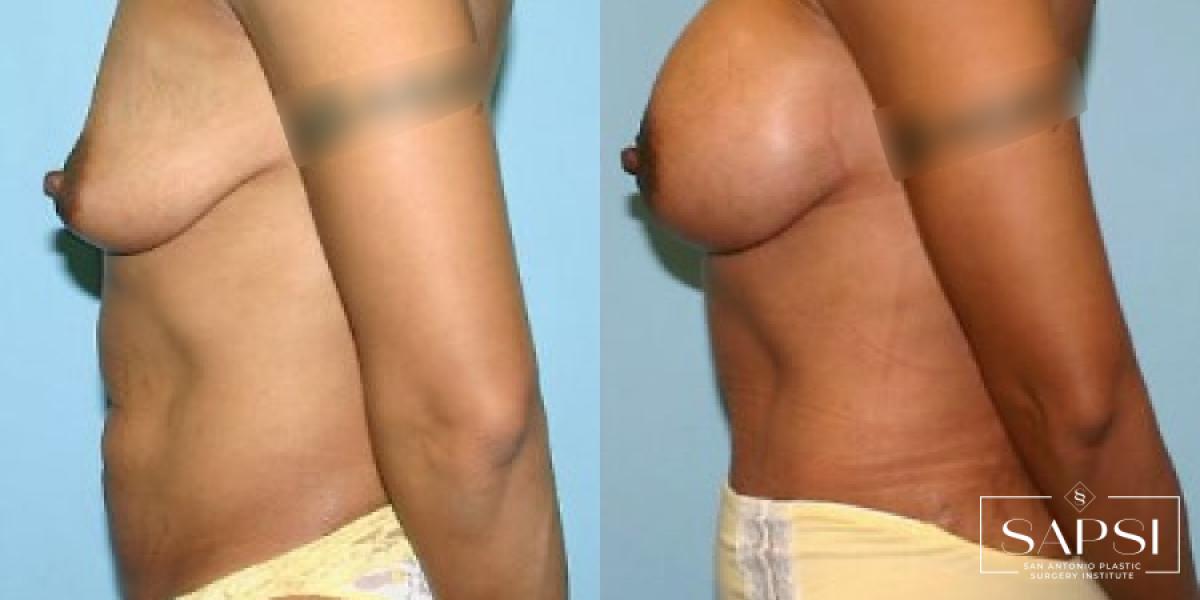 Breast Augmentation: Patient 3 - Before and After 4