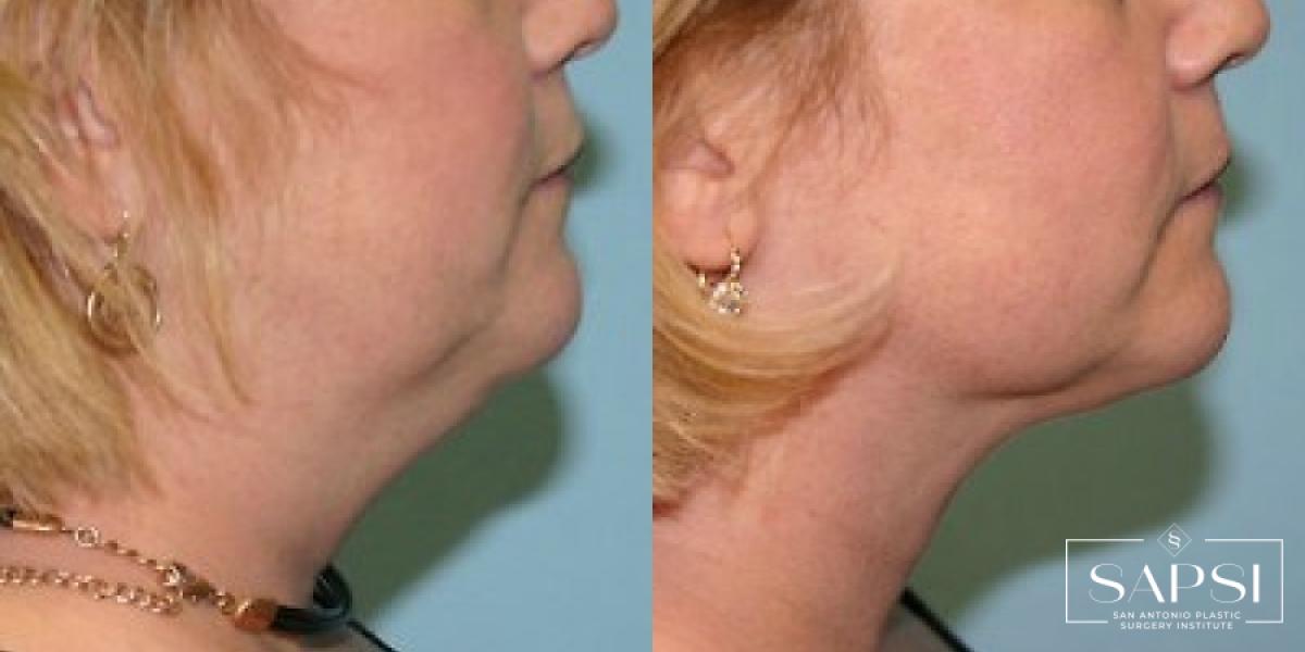 Liposuction: Patient 5 - Before and After 2