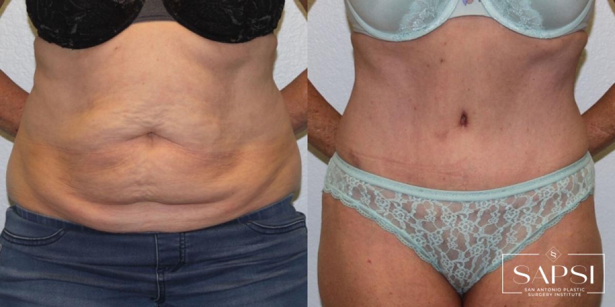 Tummy Tuck: Patient 16 - Before and After 1