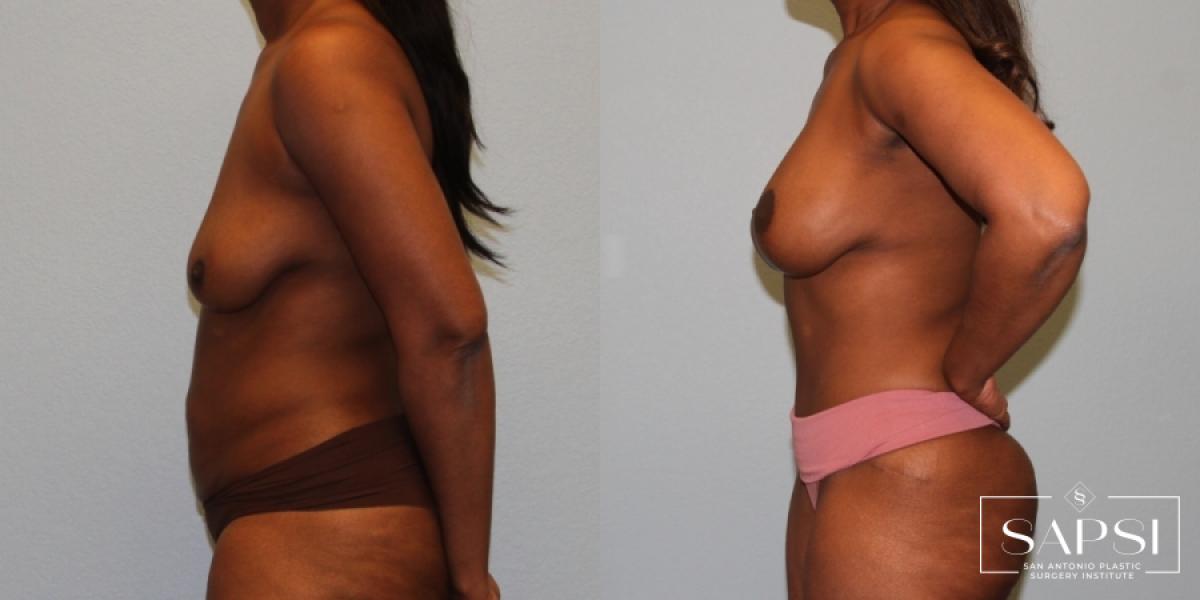 Breast Augmentation With Lift: Patient 18 - Before and After 3