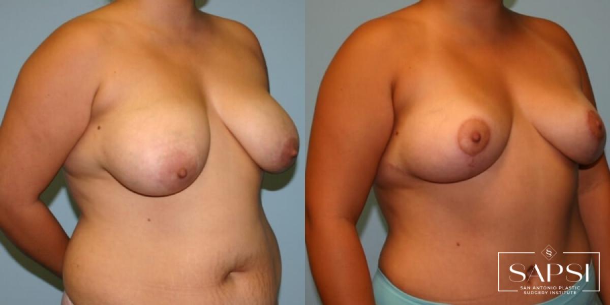 Breast Lift: Patient 17 - Before and After 2